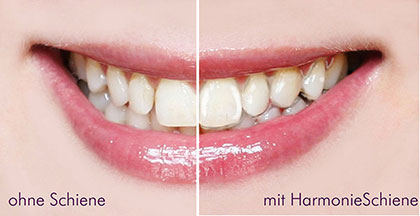 HarmonieSchiene