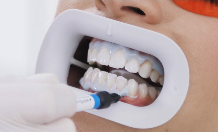 03-Gingiva_auftragen.jpg